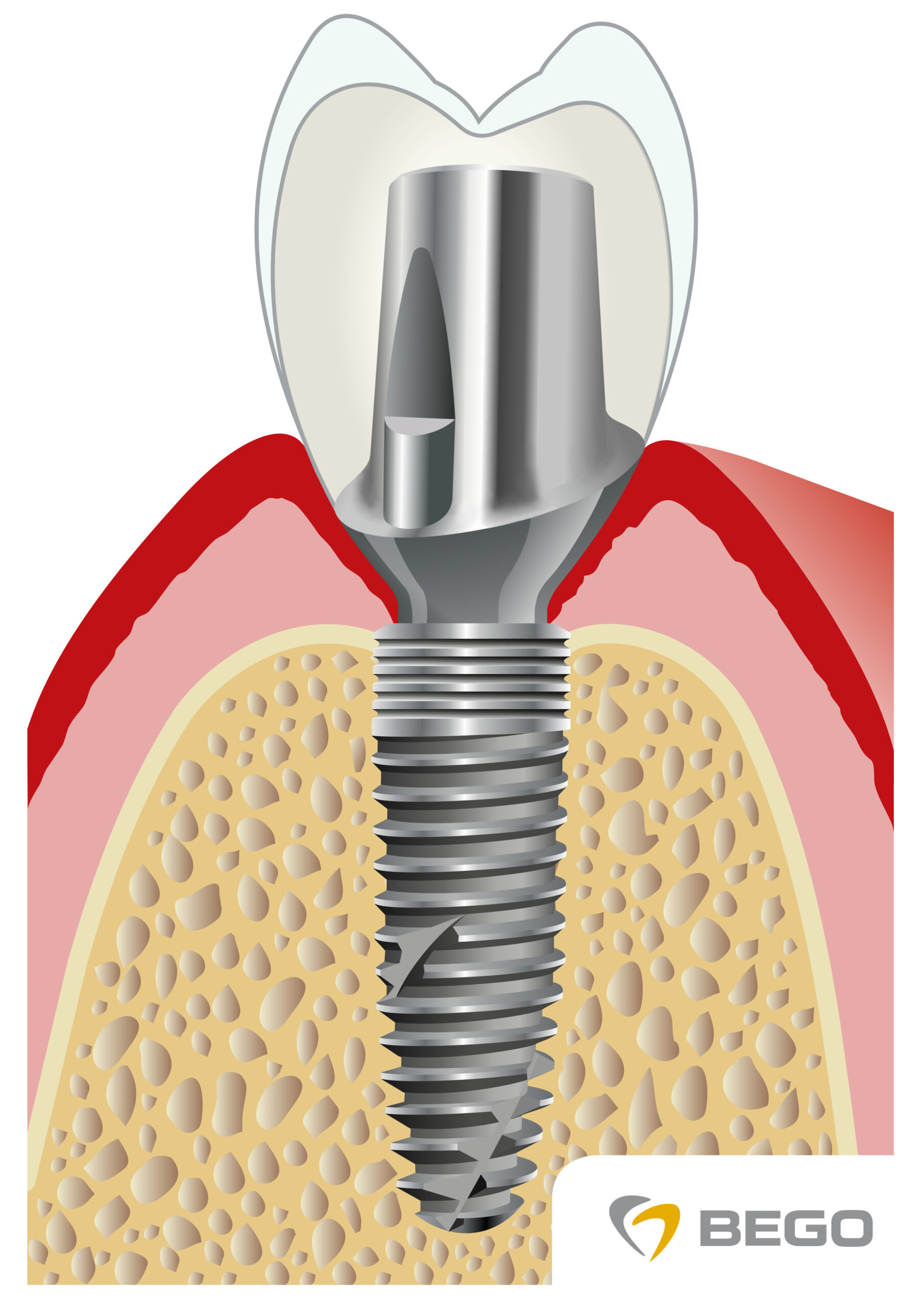 implant zębowy w kości – implantologia Ruda śląska