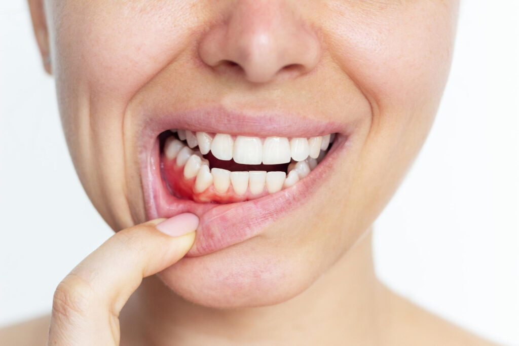 objawy chorób dziąseł periodontolog Ruda Śląska
