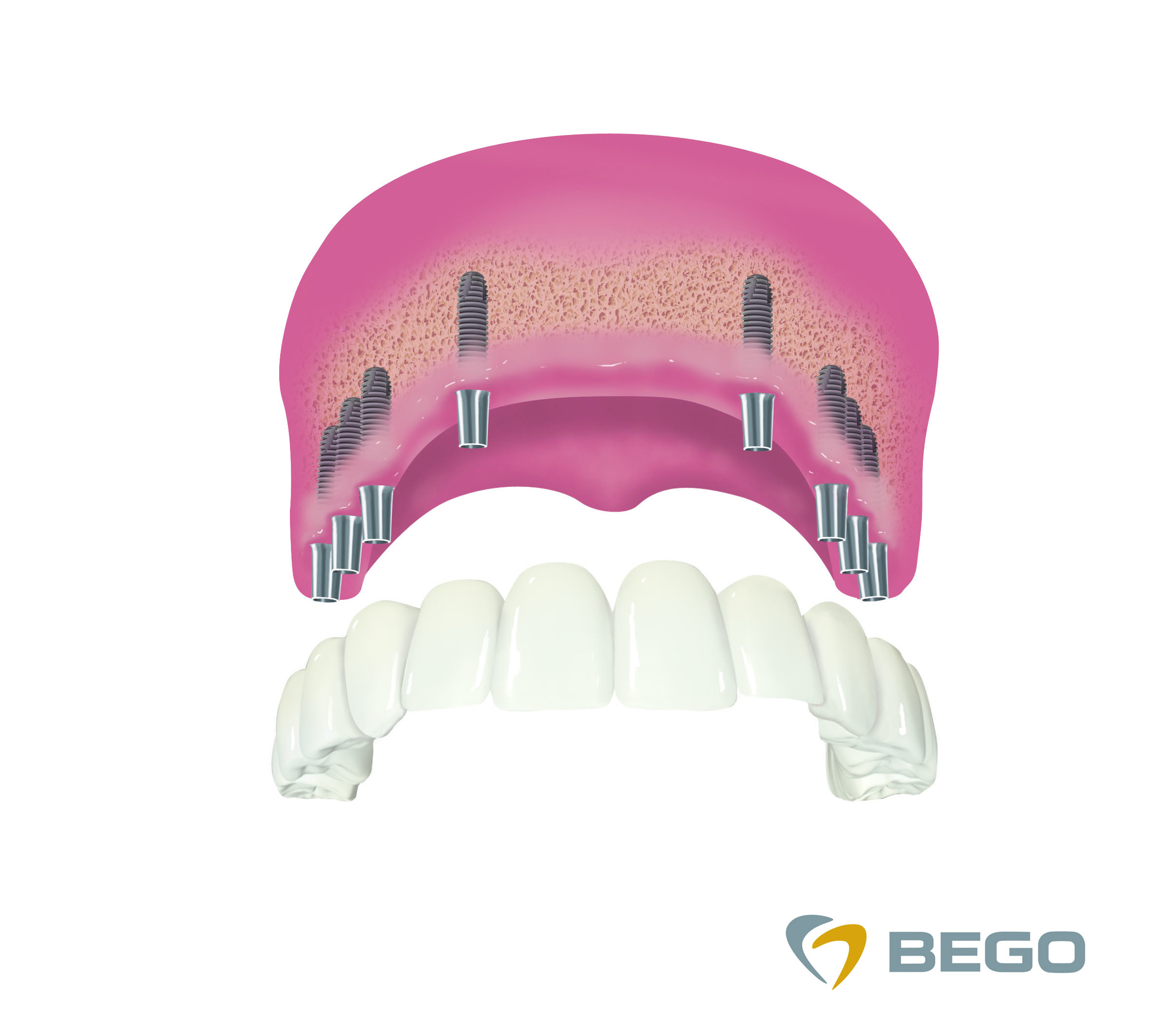 pojedynczy implant zęba – implantologia i odbudowa brakującego zęba
